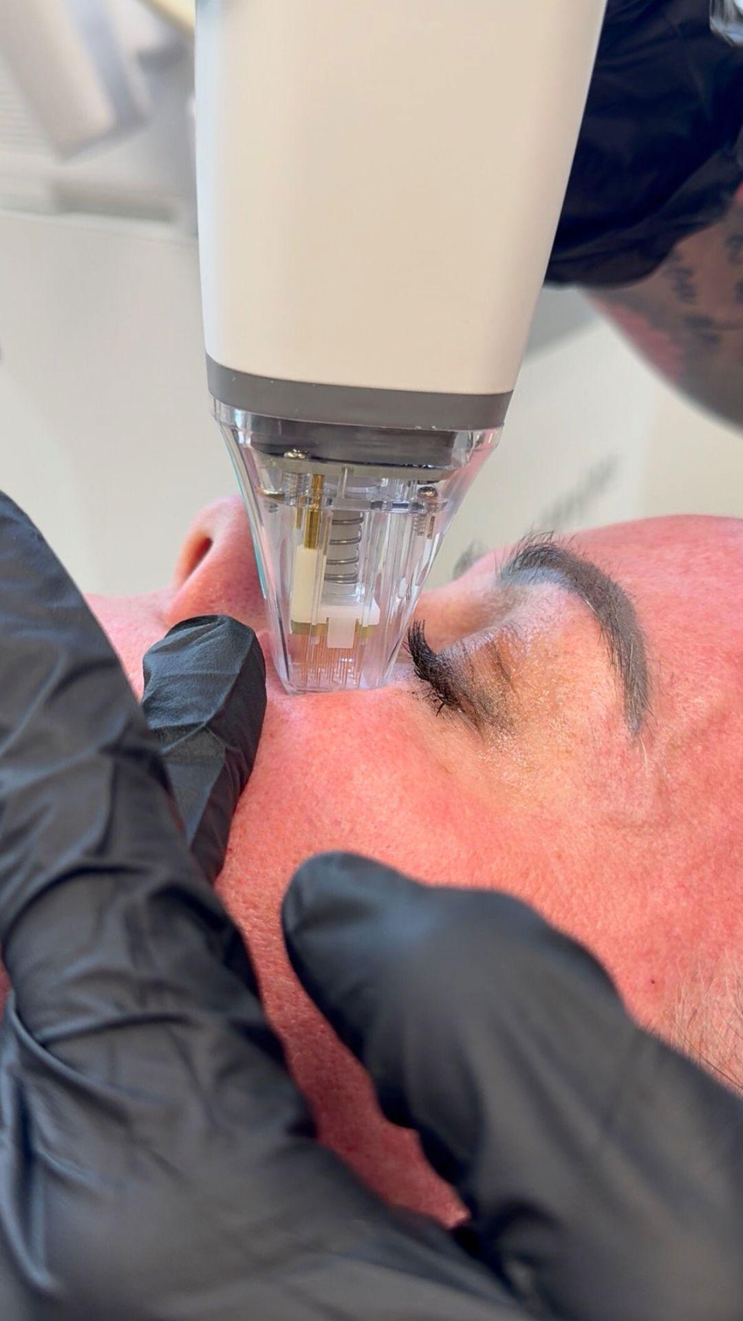 stratica-dermatology-medical-grade-uv-light-therapy stratica-dermatology-potenza-therapy
