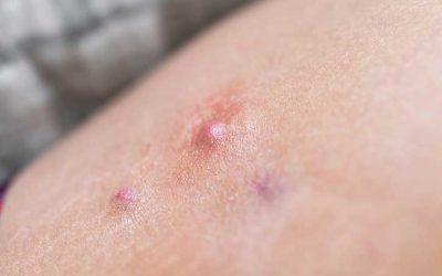 Could You Have Hidradenitis Suppurativa?