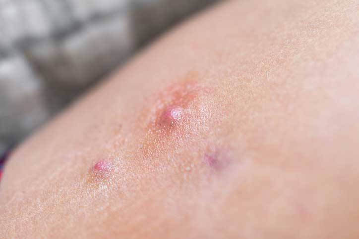 Could You Have Hidradenitis Suppurativa?