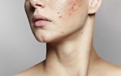 Do You Have Rosacea or Acne?