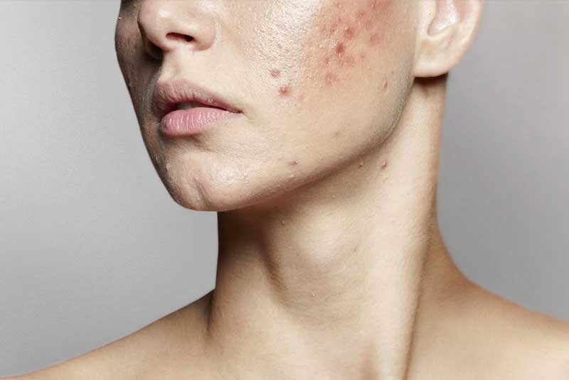 Do You Have Rosacea or Acne?