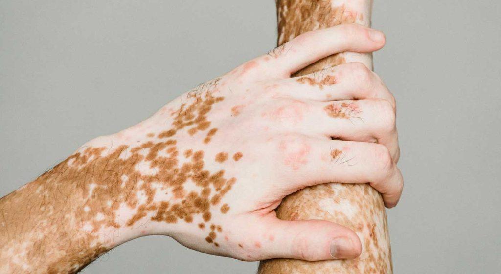 stratica dermatology vitiligo medical treatments