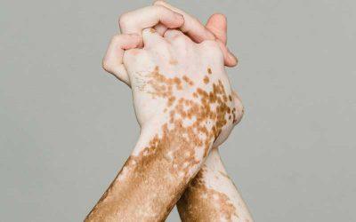 What is Vitiligo and How Do You Treat It?