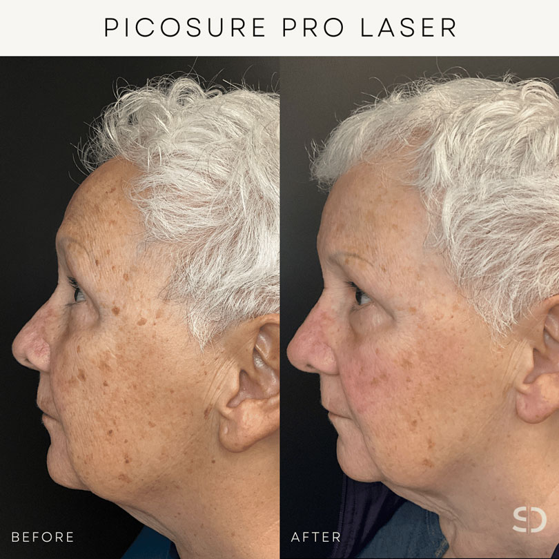 picosure pro laser stratica before and after