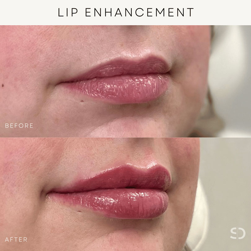 lip enchancement stratica before and after