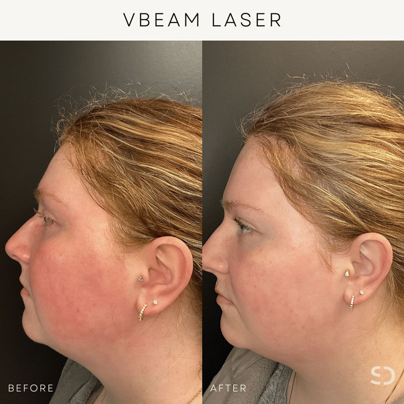 vbeam laser before and after stratica edmonton