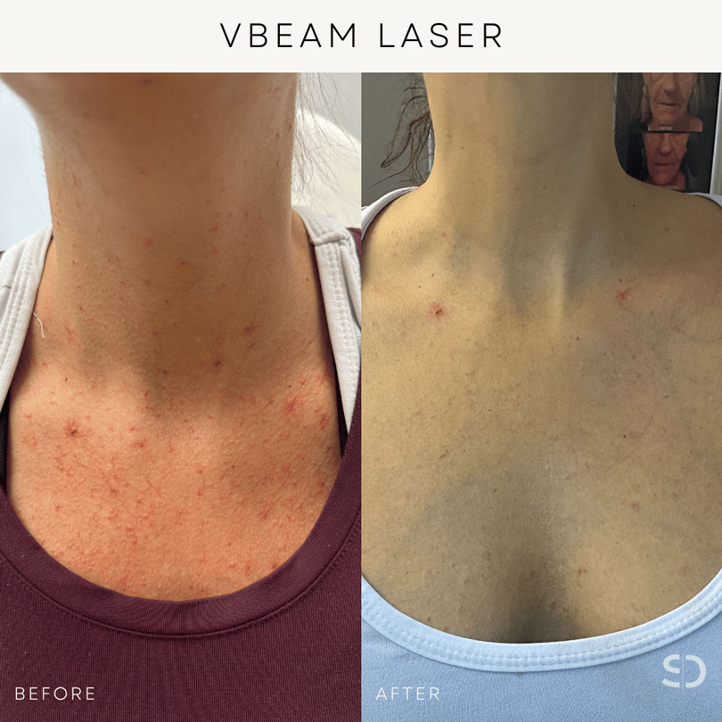 vbeam laser stratica before and after