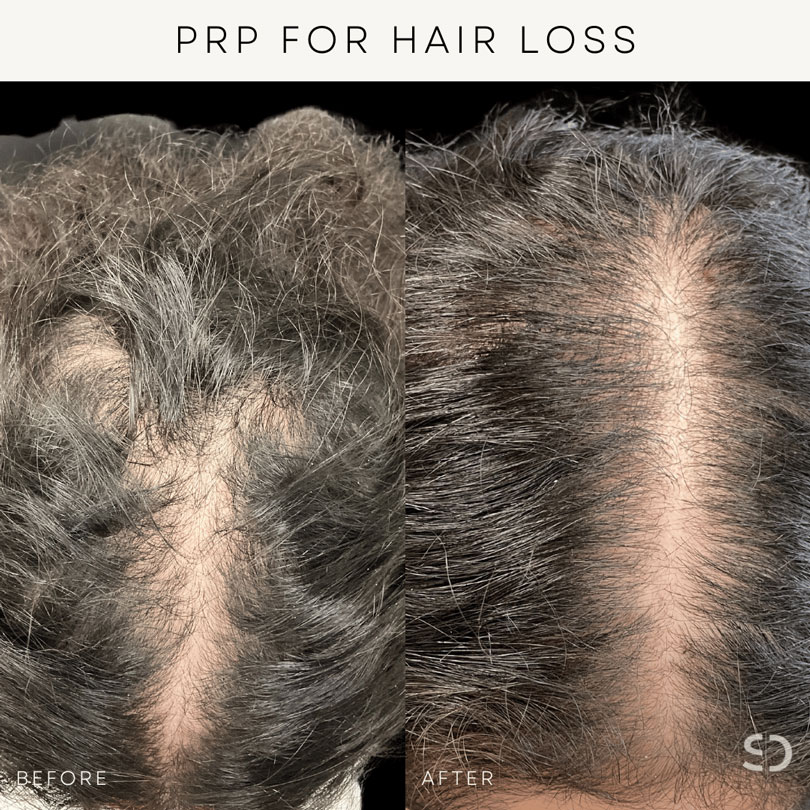 prp for hair loss stratica before and after