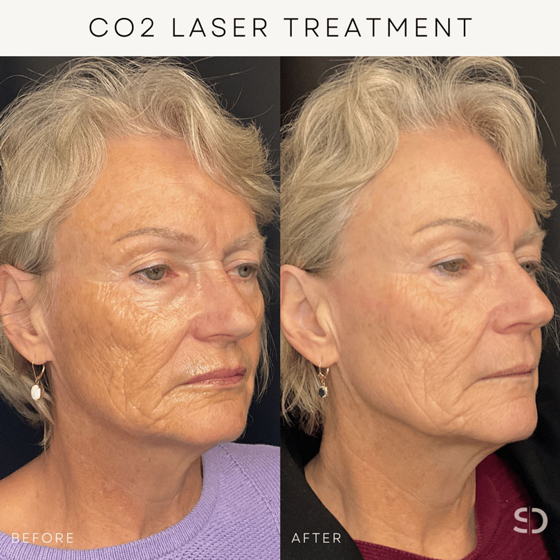 co2 laser treatment before and after stratica