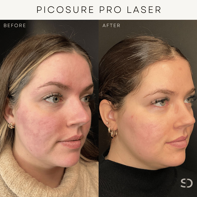 picosure pro laser before and after stratica