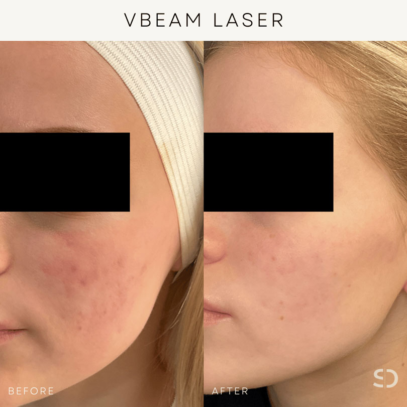 vbeam laser stratica edmonton before and after