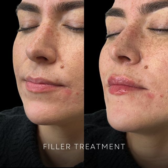Natural yet effective results ✨💋 These results were achieved with a half syringe of filler - treatment done by @beyondinjections 

Interested in filler treatments? Book your free consultation with us today to discuss your unique needs! Link-in-bio or call 587-410-4295 to book. 

#StraticaDermatology #LipFiller #Filler #Revanesse