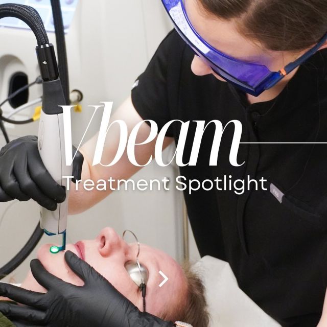 Treatment Spotlight | Vbeam Perfecta 

The Vbeam Perfecta is a world renowned system that used Pulsed Dye Laser technology to deliver laser energy into target of the skin that are either red, purple, or blue in colour. Swipe to learn more about the skin concerns this laser can treat! ✨

Interested in knowing if the Vbeam is the right treatment for you? Book your complimentary consultation with us to learn more! Link-in-bio 

#StraticaDermatology #Edmonton #vbeam