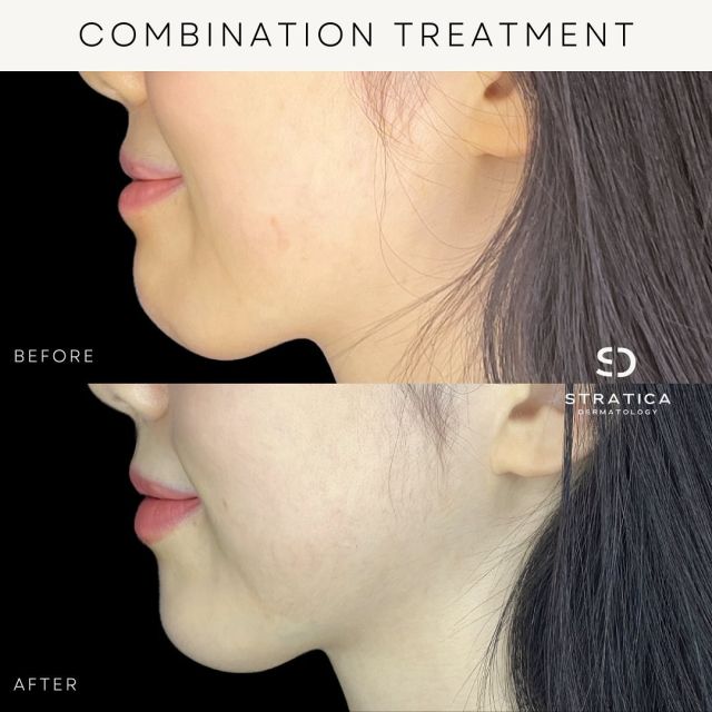 At Stratica, we’re committed to tailoring personalized journeys to help you achieve your unique skin goals 👉🏼This patient approached us with concerns about facial balancing in the lower face, and with a customized combination of treatments, we can see the result of a refreshed and harmonized balance after just one session ✨ 

Ready to discuss your unique path to your skin goals? Secure your free consultation now! 

#StraticaDermatology