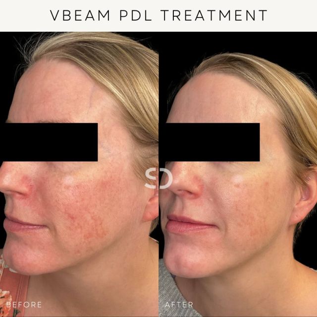 ✨ Bringing out the best in our patient's skin! ✨

Take a look at the results after just 3 Vbeam treatments! ➡️

Our Vbeam laser uses Pulsed Dye Laser (PDL) technology to deliver laser energy into target areas of the skin that are either red, purple, or blue in colour. There, the blood vessels absorb light to help reduce the size and colouration of the target area.

VBeam can treat:
✨ Rosacea
✨ Broken Blood Vessels
✨ Cherry Angiomas
✨ Red Scars
✨ Sunspots
✨ Poikiloderma
✨ Port-wine stains
✨ Spider Veins and Angiomas

Have any questions about the Vbeam laser or want to see if it aligns with your skin goals? Book a complimentary consultation online, DM us, or call us at 587-410-4295 to book 📲

#StraticaDermatology #YEGDermatology #VBeamLaser #LaserTherapy #RosaceaTreatment