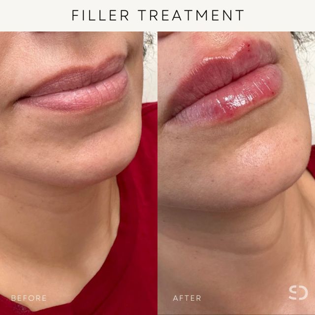 Enhanced beauty, naturally perfected with @beyondinjections 👄 💉

"We began with half a syringe during the appointment, but her lip tissue was able to handle a full syringe! She left the clinic obsessed with her new lips."

Our cosmetics team on the 3rd floor of our building is ready to help you achieve beautifully juicy and structured lips. 🫶🏼

Nurse Trish offers complimentary consultations. Book your appointment using the link in bio or call 587-410-4295 to book.