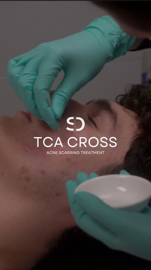 Follow a TCA Cross for Acne Scarring Treatment by @dermnurseandrea ✨

At Stratica, we work with you to develop custom treatment options that meet YOUR specific skin needs. 
We understand that not everyone responds to treatment plans the same way. Having your cosmetic needs treated a dermatology clinic means being sure to receive expert-backed treatments to bring out the best in your skin. 

Start your acne treatment journey with a free consult on us 💌 Link in bio to book! 

#acnescars #acnescartreatment #acnetreatment #tcacross