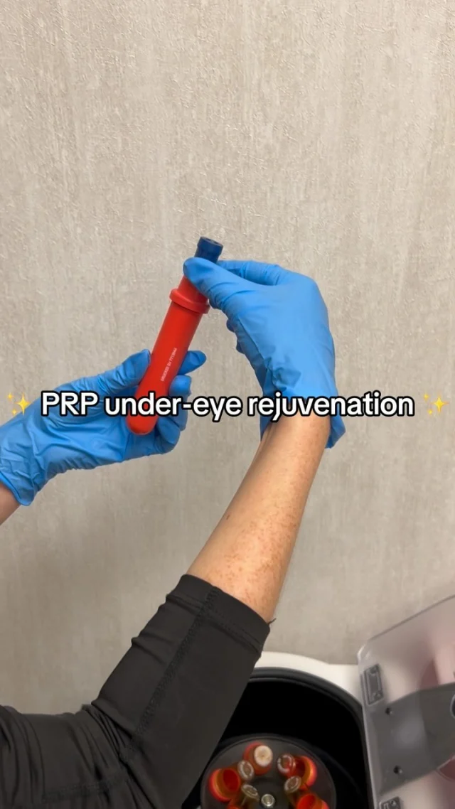 ✨PRP Under-Eye Rejuvenation✨

Using your body’s own “liquid gold” (Platelet-Rich Plasma), this treatment rejuvenates under-eye skin, boosting collagen with minimal downtime!

Ideal for: ▫️Dark circles ▫️Fine lines ▫️Thinning skin

Curious if it’s right for you? Book a free consult—link in bio! 💉💛

#prptreatment #yeg #yegcosmetics #cosmeticinjections #undereyetreatment #darkundereyes #edmonton