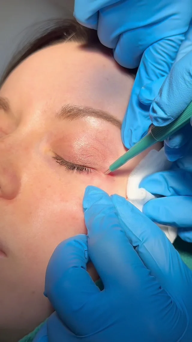 A quick and seamless procedure! ✨ Watch Dr. Ladha remove a small cyst near the eye in just minutes.

Cysts are common, but they don’t have to stick around. If you’re ready to have yours removed, ask your family doctor for a referral to see us—your skin will thank you. 🤍