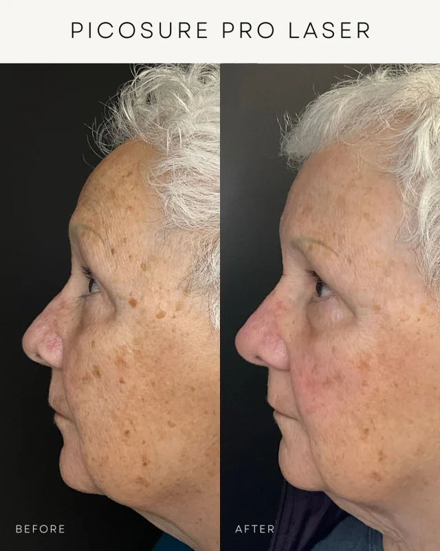 After 3 treatments with our PicoSure Pro Laser 🙌🏻✨

This laser is designed to effectively treat:
✔️ Brown spots
✔️ Sun damage
✔️ Hyperpigmentation
✔️ Uneven skin tone

And the best part? There’s minimal downtime! Meaning you can get back to your routine in no time! 🫶🏼

Visit our website, DM us, or call us at 587-410-4295 to schedule your appointment📲

Stay tuned for more progress updates!