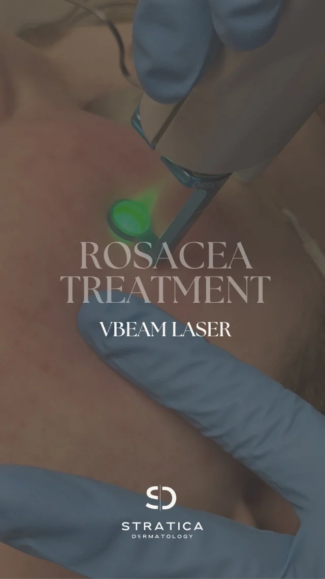 Trying a new treatment can feel intimidating, but trust the process… it’s worth it! 💆‍♀️✨

 In this video, we’re using our VBeam laser, which works wonders for:

✨Rosacea
✨Red scars
✨Vascular irregularities 

If you have questions about what’s right for you, we’re here to help! Book a free consultation on our website, DM us, or call 587-410-4295!📲💖