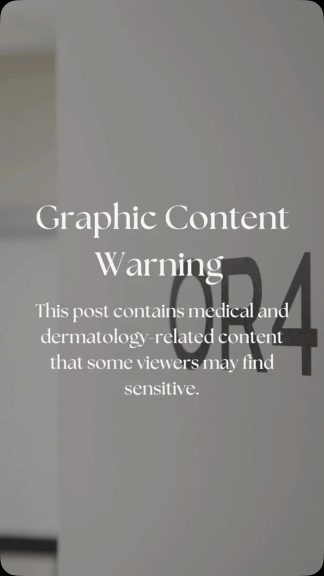 May is Skin Cancer Awareness Month—but protecting your skin is something we should think about all year long. ☀️

In this video, we’re removing a severely dysplastic nevus, also known as an atypical mole. These types of moles show abnormal cells under the microscope and can sometimes look similar to melanoma. 

While they aren’t cancerous, they can carry a higher risk of turning into skin cancer over time—especially if they’re changing, growing, or have irregular borders or colors.

With summer on the way, now is the time to make SPF a daily habit (and remember to reapply!)—and to keep an eye on your skin. If you notice a mole that’s new, changing, or just doesn’t feel right, talk to your family doctor about getting a referral to Stratica Dermatology. 

Early detection makes all the difference 💛