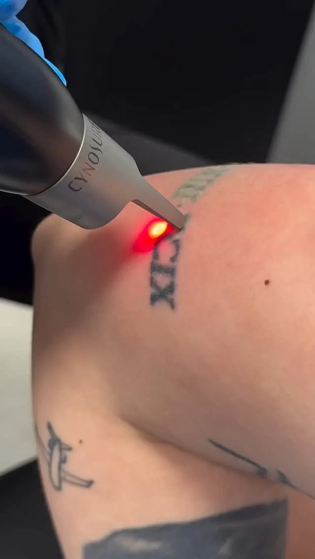 What is “icing” during laser tattoo removal? ❄️

If you’ve ever noticed a white, frosty-looking layer on the skin right after treatment—that’s called icing.

Kelly, our laser tech in St. Albert, explains how it happens and why it’s totally normal. It’s a temporary reaction caused by rapid energy hitting the pigment, and it usually fades within minutes.

Just one of the ways your skin shows the laser is doing its job!

👉 If you have a tattoo you’re thinking about removing, or want to learn more about our Pico laser, book an appointment through the link in our bio or on our website! 📲