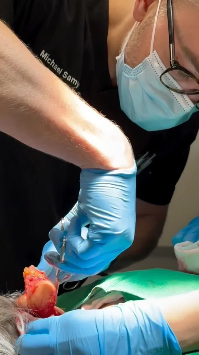 Another satisfying removal from Dr. Samycia ✂️

This lipoma had been sitting under the skin for over 10 years. Lipomas are slow-growing, non-cancerous lumps made up of fat—usually harmless, but they can become uncomfortable or bothersome over time.

If you’ve noticed a growing bump, talk to your family doctor about getting a referral to Stratica Dermatology 💕